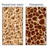 Osteoporosis (Bisphosphonate) Drugs