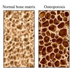 Beware Osteoporosis Drugs Medication