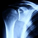 Reversing Osteoporosis